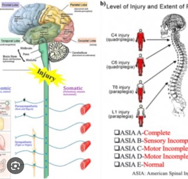 Epidural stimulation patient progress